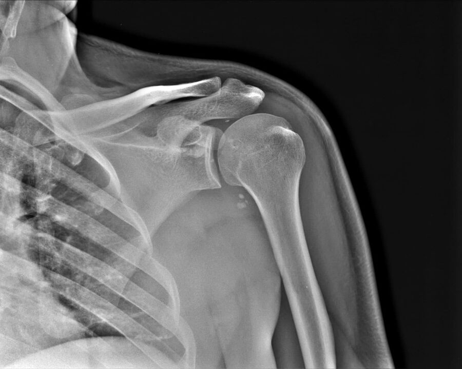 X-ray of osteoarthritis of the shoulder joint of the 2nd degree of severity
