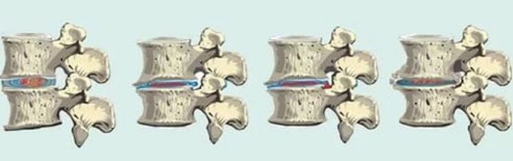 spinal injury in cases of thoracic osteochondrosis