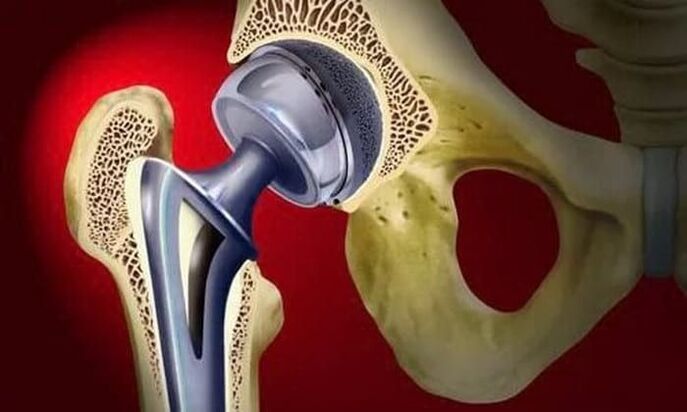 hip arthroplasty for osteoarthritis