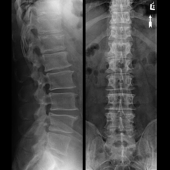 X-ray of the chest region, which shows a decrease in the gap between the vertebrae along the spine from the bottom up