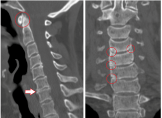 CT scan shows damaged vertebrae and discs of heterogeneous height due to thoracic osteochondrosis