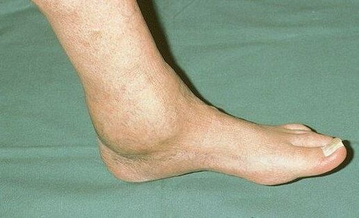 ankle swelling with osteoarthritis