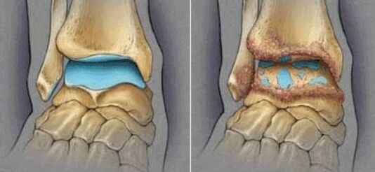 healthy osteoarthritis of the joints and ankle