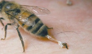 treatment of osteoarthritis of the hip by bees