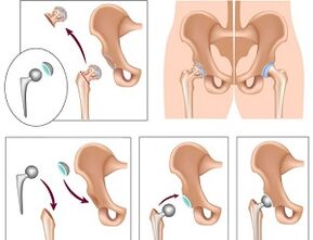 endoprostheses for hip osteoarthritis