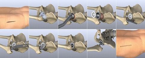 methods of treating hip osteoarthritis